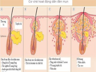 AZACNÉ – “VŨ KHÍ” MỚI GIÚP XÓA SỔ MỤN TRỨNG CÁ VIÊM